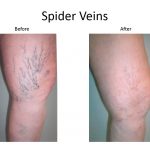Sclerotherapy - Denver Vein Therapy