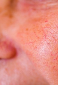 Facial Spider Veins