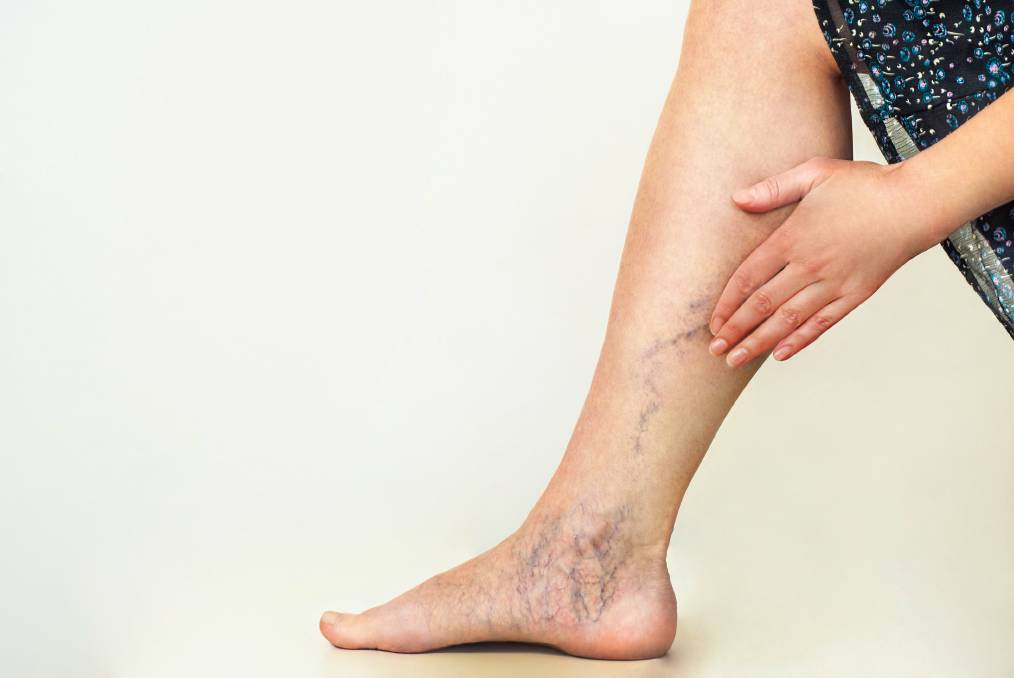 How Do Compression Socks Help My Varicose Veins? - Denver Vein Center