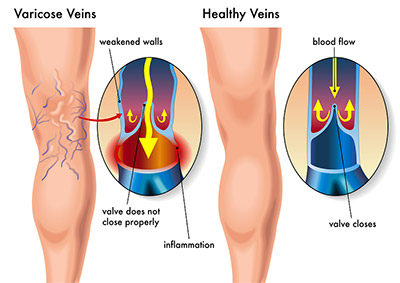 Vein Treatments