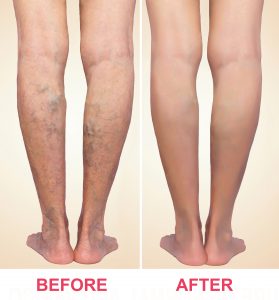 Painless Spider Vein Treatment, Removal