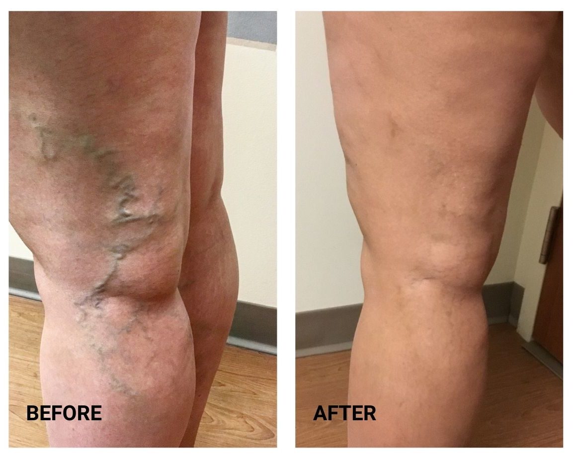 Should I Be Concerned About Dark Veins? - Denver Vein Center