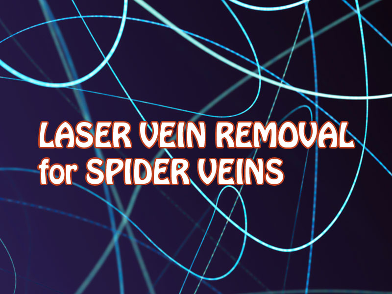 laser light imagery to illustrate laser vein removal for spider veins
