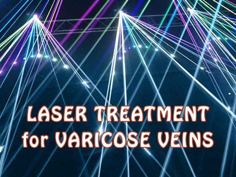 laser image to illustrate laser treatment for varicose veins