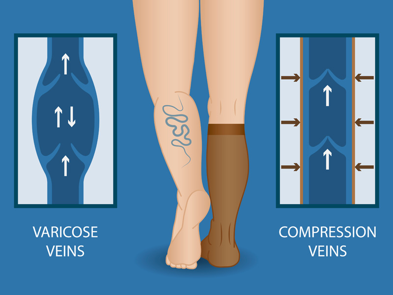 diagram showing the difference made to varicose veins by compression socks