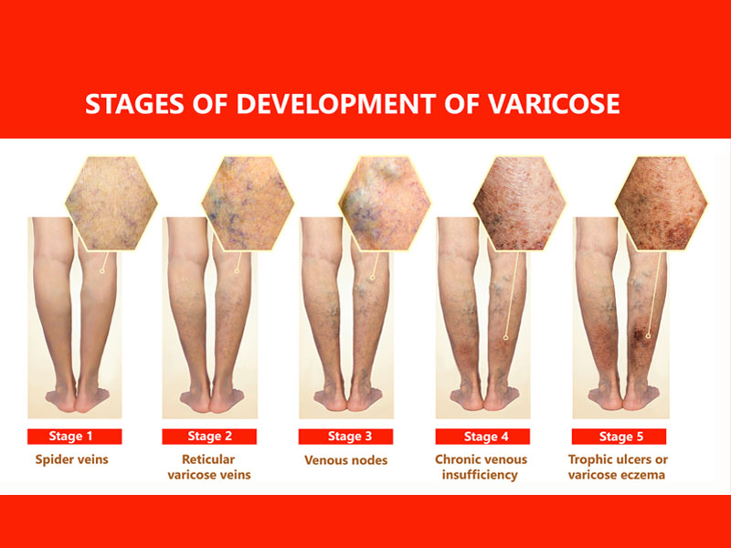 graphic of stages of how venous ulcers form