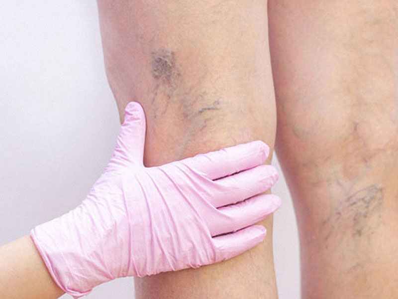 examination of leg veins to illustrate vein doctor near me