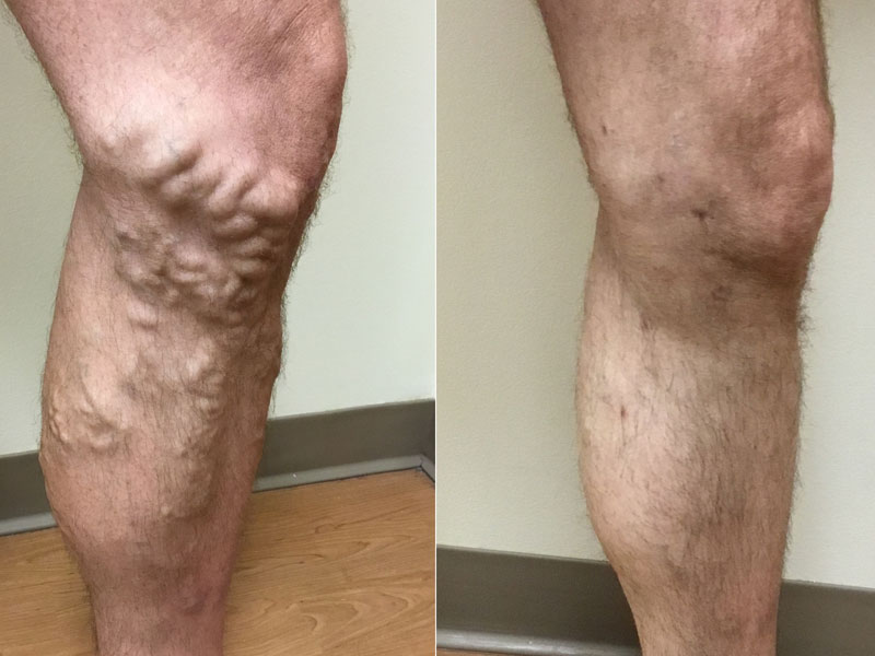 Before and after images of a man's leg to illustrate that men get varicose veins too