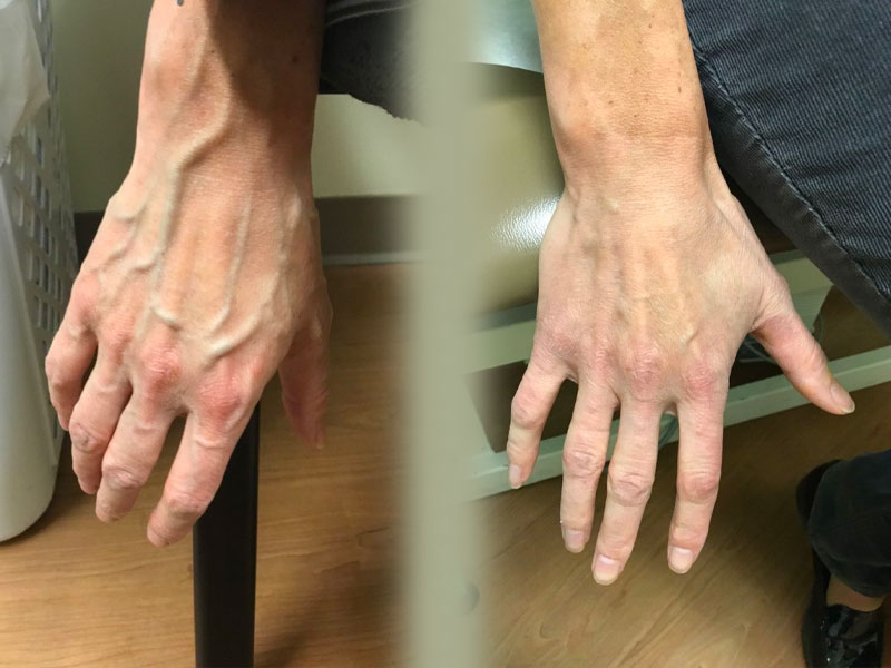 hands showing visible veins before and after treatment