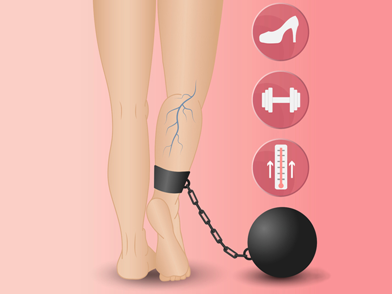 Two legs, one with a ball and chain and a varicose vein to illustrate how weight affects your veins