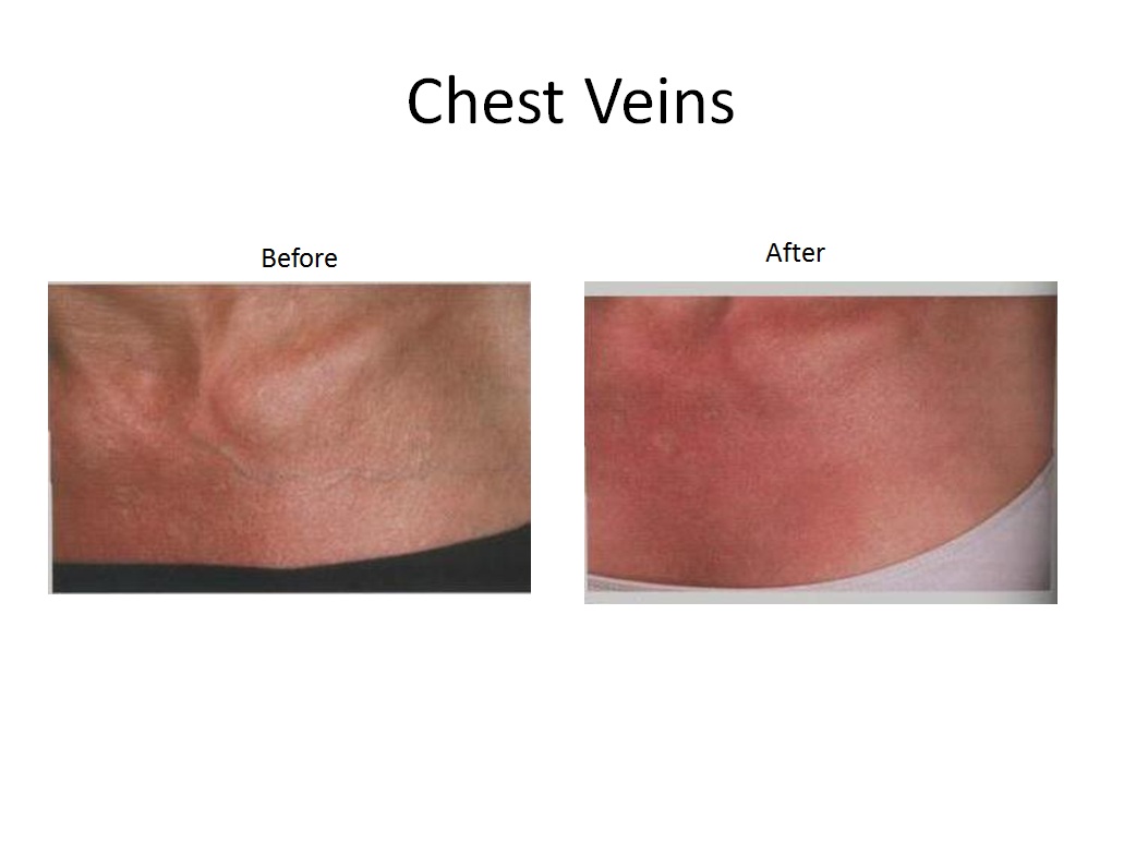 Other Veins Denver Vein Center