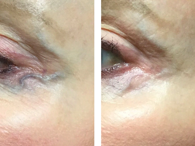 before and after images from sclerotherapy for visible facial veins around the eyes