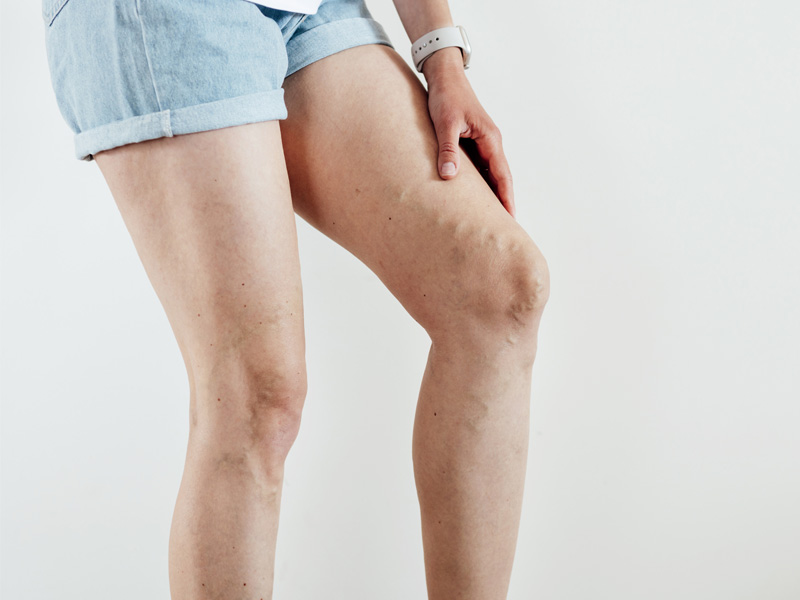 Woman's legs with varicose veins to illustrate the new Varithena treatment