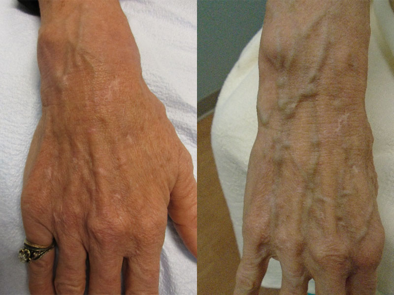 hand showing before and after images of treatment for hand veins